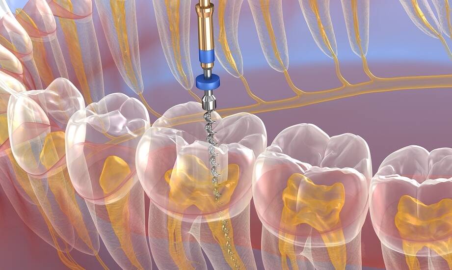 Bezbolesne zabiegi resekcji wierzchołka korzenia zęba dzięki nowoczesnym technologiom