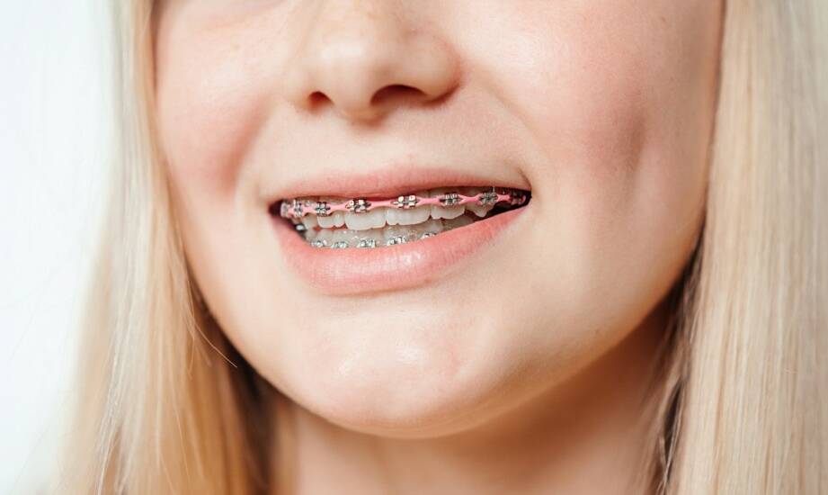 Aparat estetyczny – czy to dobry wybór dla dzieci?