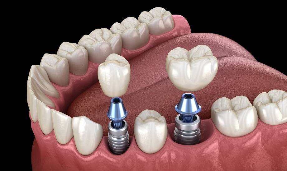 Dlaczego implanty zębowe są trwalsze niż tradycyjne protezy?