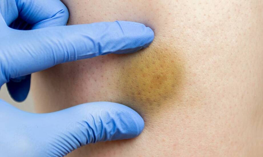 Jak hirudoterapia wpływa na redukcję stanów zapalnych w ciele