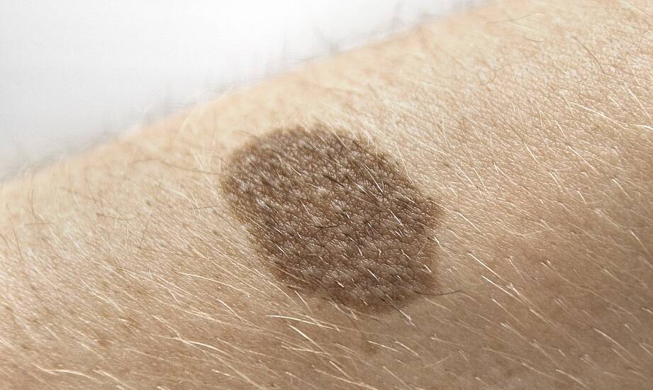 Jak gabinet medycyny estetycznej może pomóc w usuwaniu przebarwień skóry?