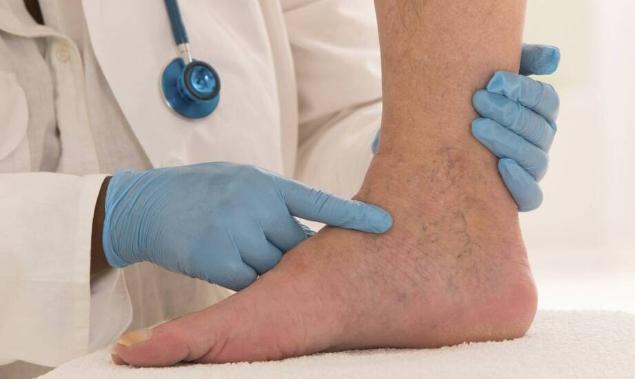 Rola flebologa w procesie leczenia powierzchownego zapalenia zakrzepowego żył