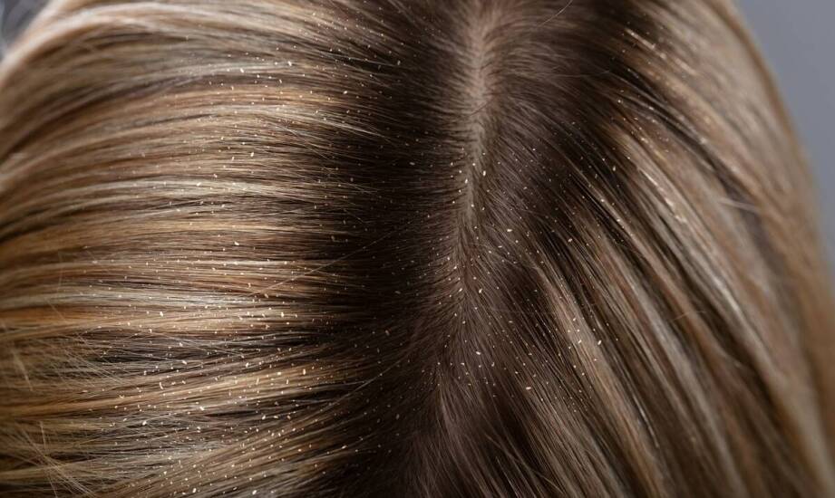 Trychologiczne podejście do problemów z wypadaniem włosów