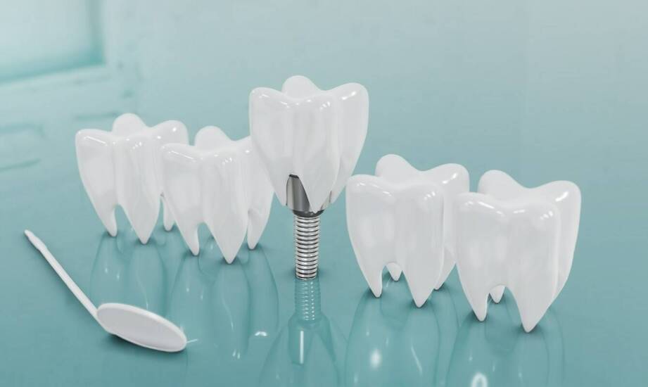 Indywidualne implanty a tradycyjne zębowe mosty: różnice i zalety