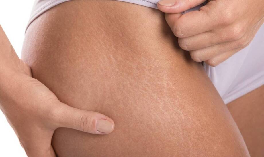 Skuteczność polimlekowego kwasu w likwidacji rozstępów