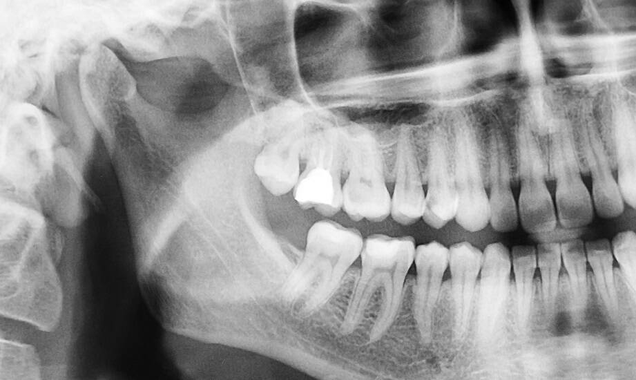 Wpływ dokładności pomiarów rentgenowskich na planowanie zabiegów