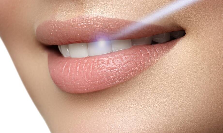 Jakie są najnowsze technologie stosowane w wybielaniu zębów?