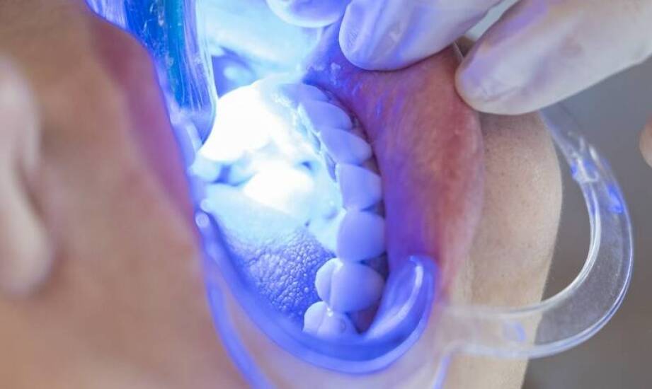 Znaczenie regularnego usuwania nazębnego kamienia dla zdrowia ustnej jamy