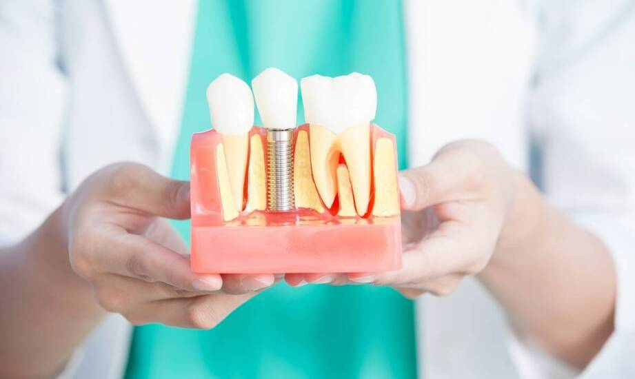 Wpływ diety na sukces implantacji zębów