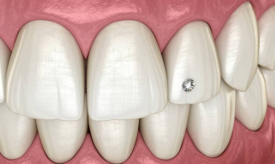 Czy porcelanowa korona może wymagać wymiany?