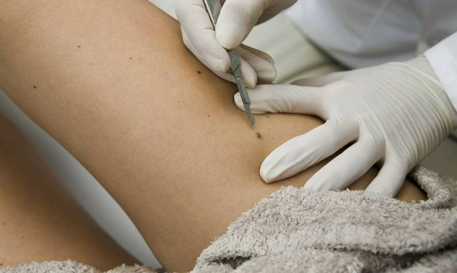 Jak wygląda przygotowanie do usuwania znamion barwnikowych?