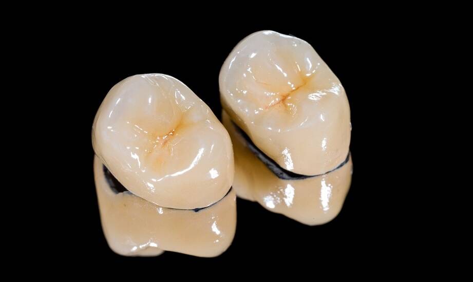 Jak wybrać odpowiedni rodzaj korony na implanty do swoich potrzeb?