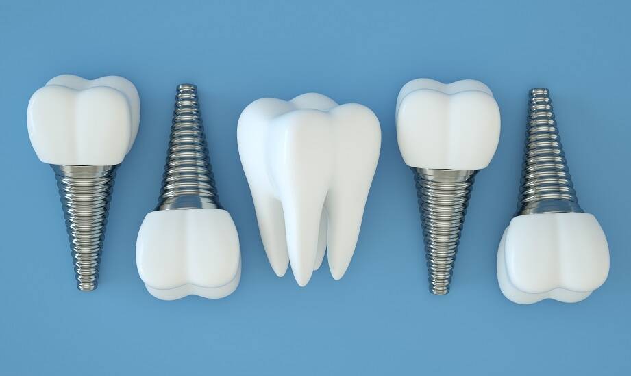 Najczęstsze pytania pacjentów dotyczące stomatologicznych implantów