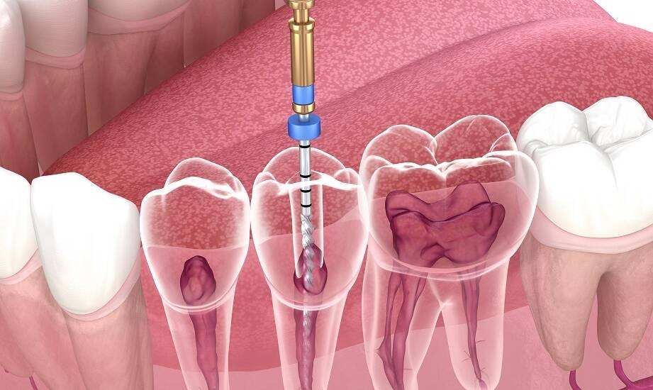 Proces leczenia kanałowego krok po kroku: co musisz wiedzieć
