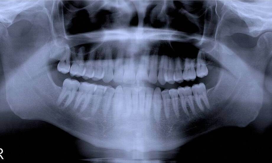 Dlaczego obrazowa diagnostyka jest kluczowa przed wszczepieniem implantów?