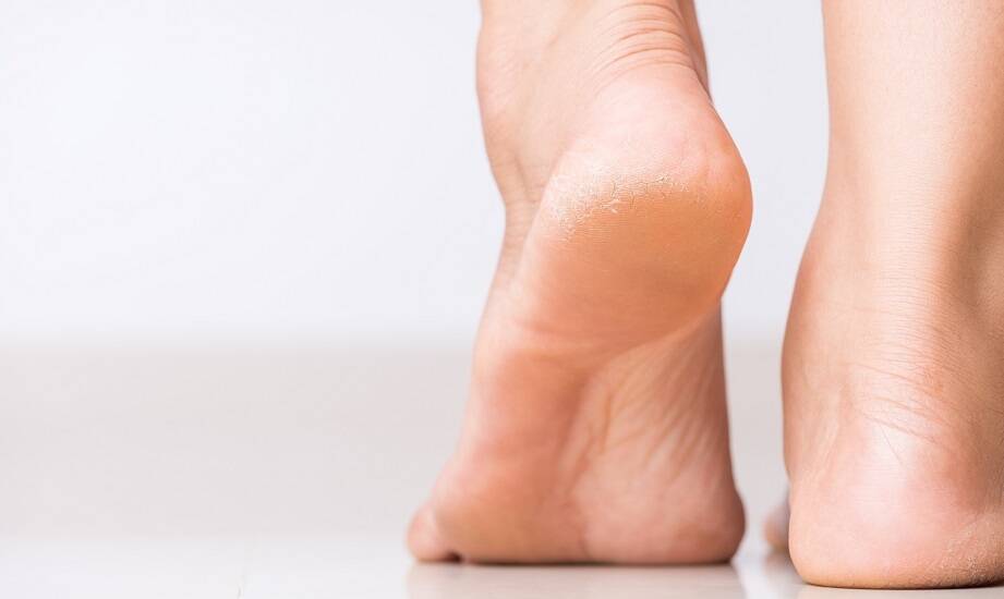 Efektywne metody leczenia spękanych pięt w gabinecie podologicznym