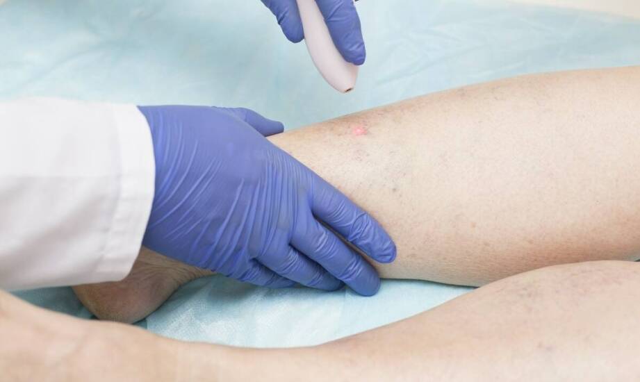 Zapalenie powierzchownych żył - jakie są pierwsze objawy i jak je rozpoznać?