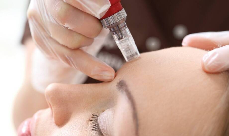 Korzyści z zastosowania Dermapenu w rewitalizacji skóry