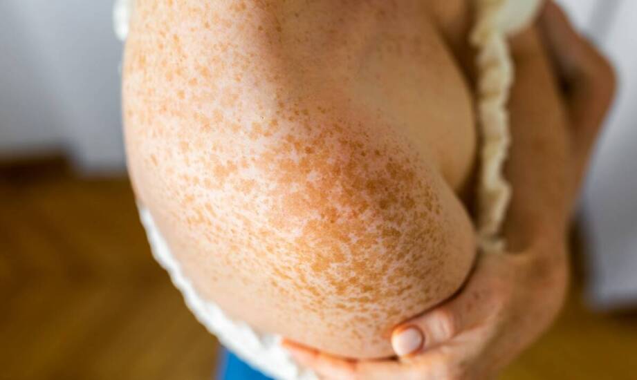 Jakie blizny można usunąć dzięki zaawansowanym technologiom?