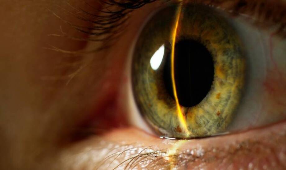 Długoterminowe efekty po zabiegu laserowej korekcji krótkowzroczności