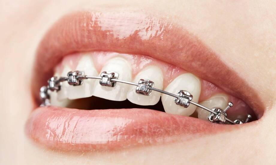 Jakie innowacje wprowadzono w aparatach ortodontycznych nowoczesnych?