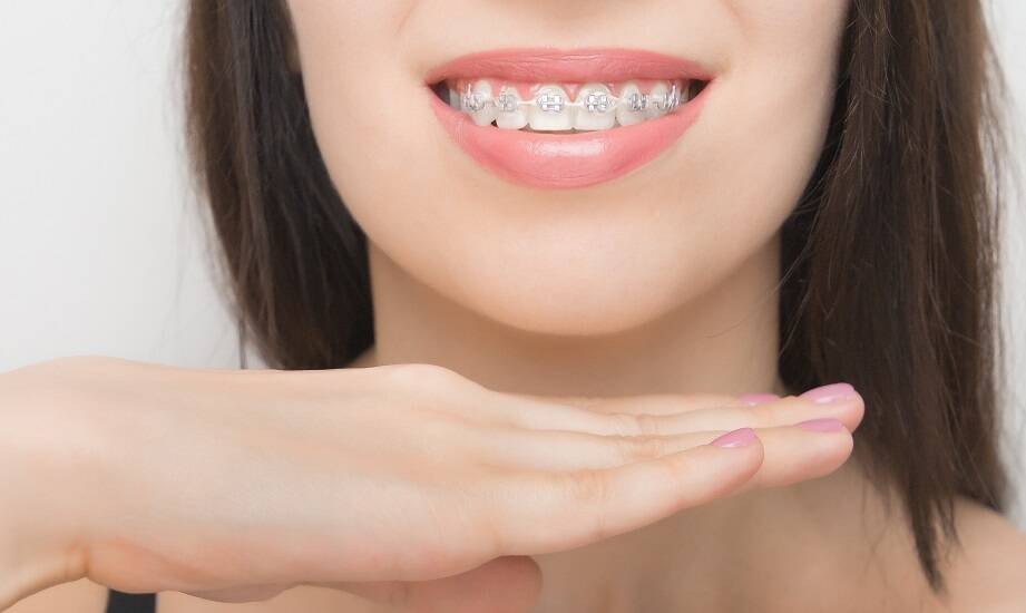 Jakie są dostępne rodzaje samoligaturujących aparatów?