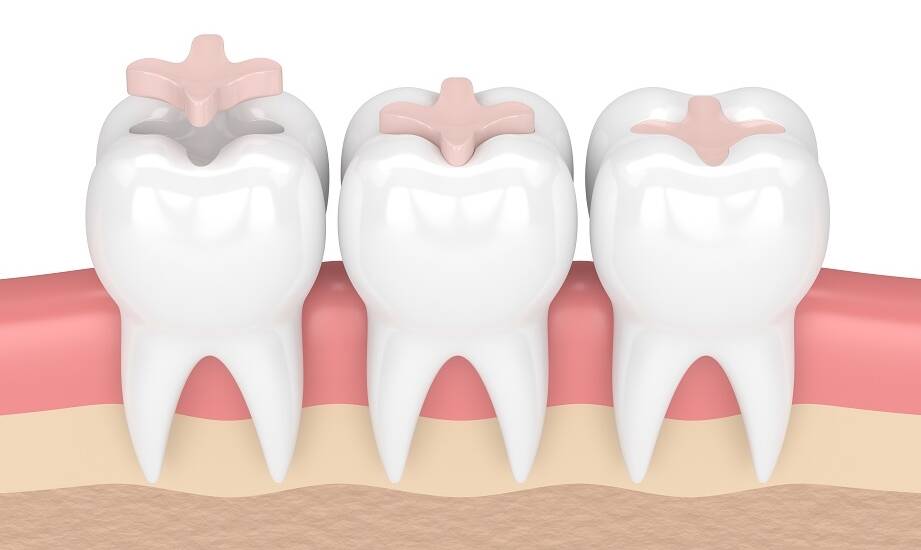 Porównanie różnych metod zamykania luk między zębami – co oferują nowoczesne technologie?