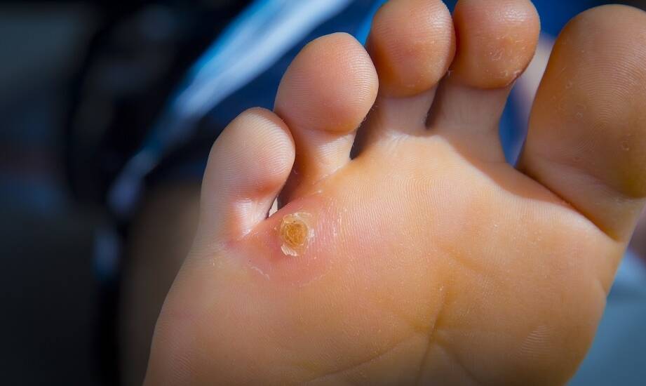 Bezpieczne techniki stosowane w gabinecie podologicznym do usuwania modzeli