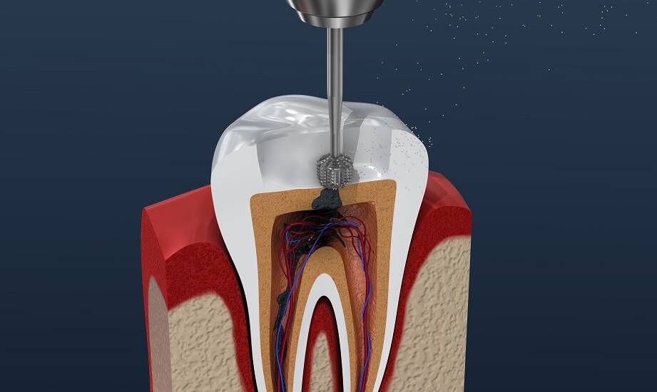 Leczenie kanałowe z użyciem najnowszych technologii – co warto wiedzieć?