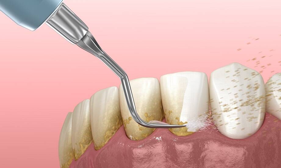 Profesjonalne czyszczenie zębów jako podstawa zdrowego uśmiechu.