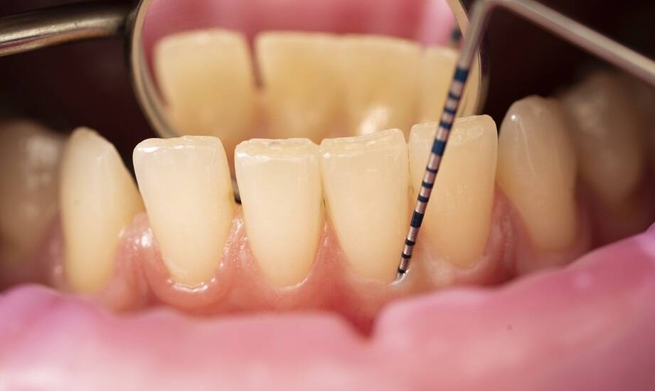 Periodontologia jako klucz do zdrowych dziąseł i kości szczęki.