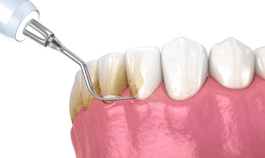 Skuteczność piaskowania i skalingu w profilaktyce stomatologicznej