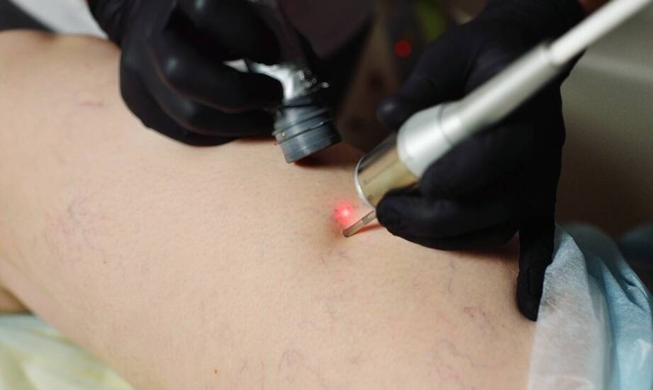 Usuwanie blizn po oparzeniach: jakie są najnowsze techniki w dermatologii?