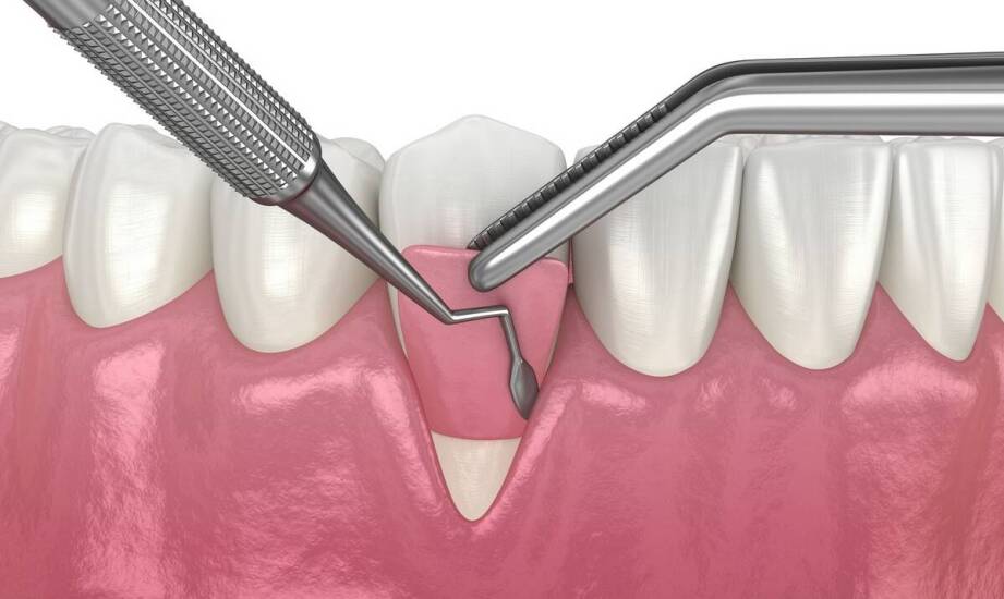 Rola periodontologii w utrzymaniu zdrowych dziąseł