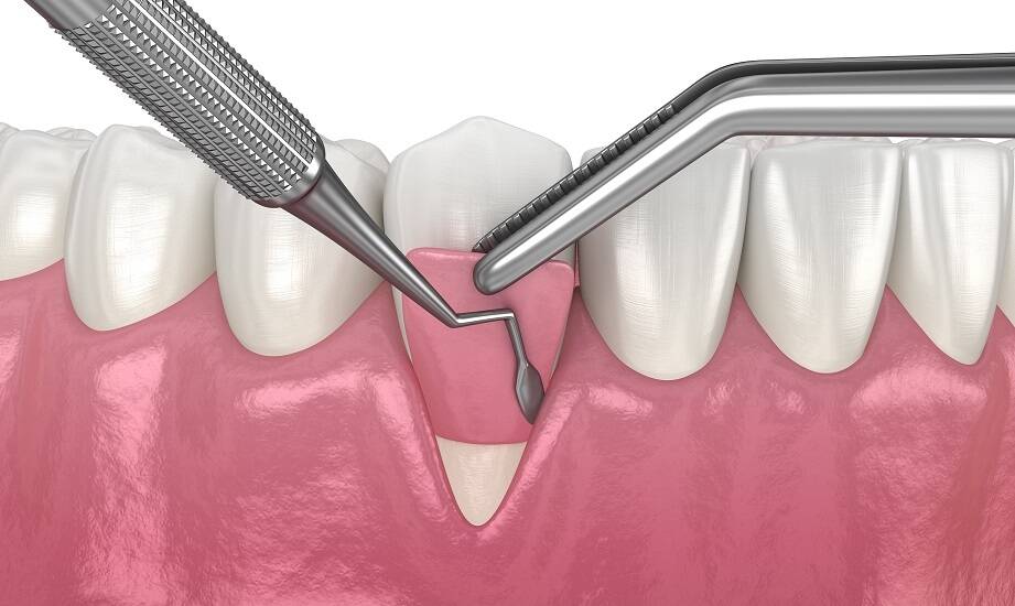 Znaczenie precyzyjnego planowania zabiegów w stomatologicznej chirurgii