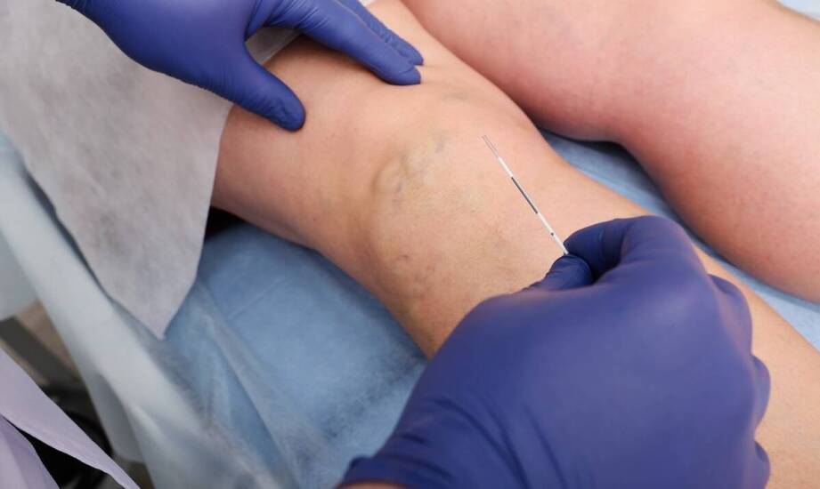 Czy laserowe usuwanie żylaków jest bolesne?