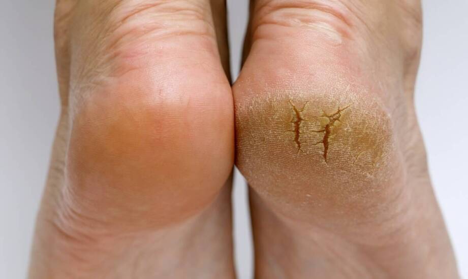 Wpływ stylu życia na zdrowie i kondycję pięt.