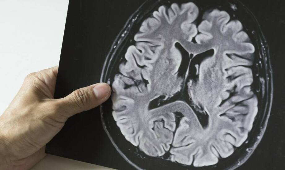 Czy istnieją metody profilaktyki oponiaka węchowej rynienki?