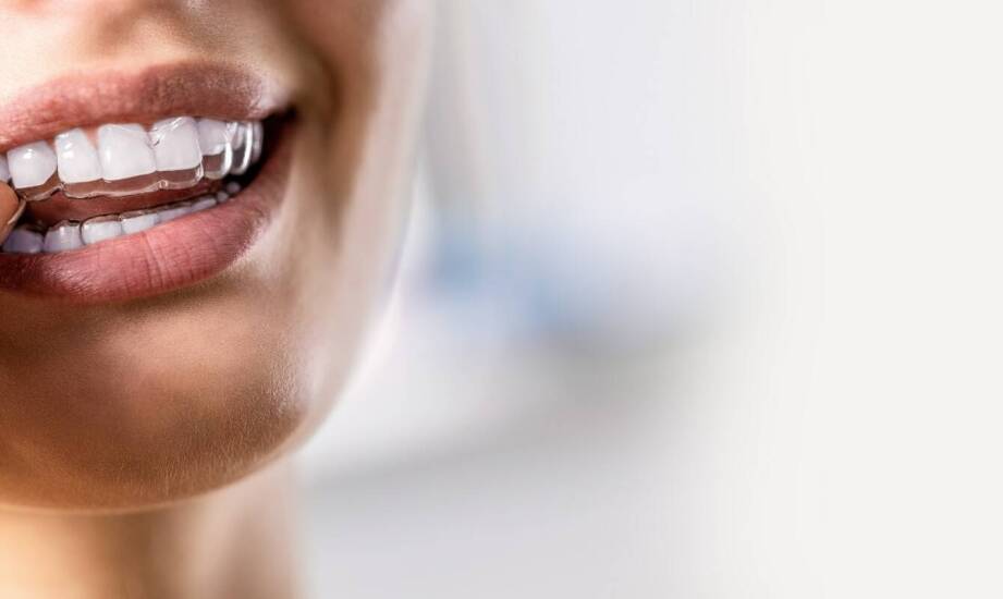 Wpływ regularnego używania szyn do wybielania na estetykę uśmiechu