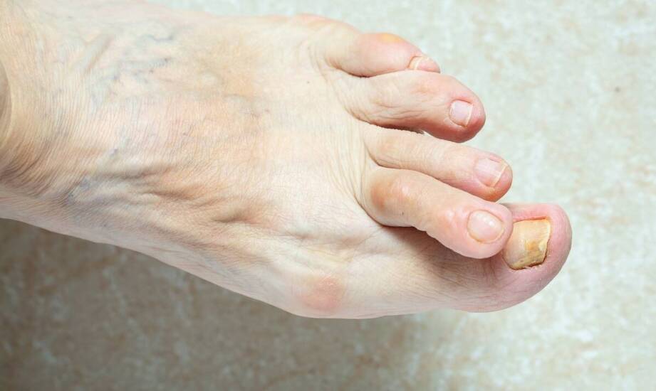 Jakie czynniki zwiększają ryzyko wystąpienia haluksów?