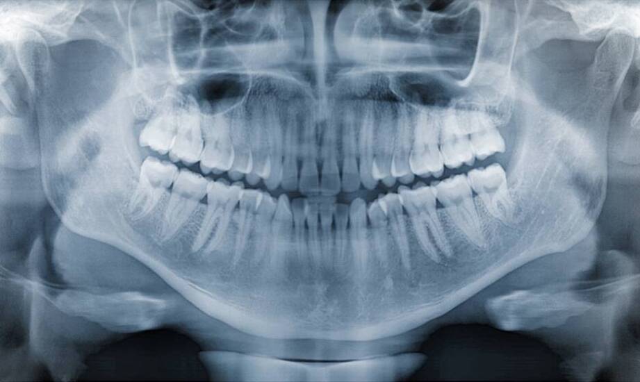 Jakie są zalety stożkowej tomografii w stomatologii?