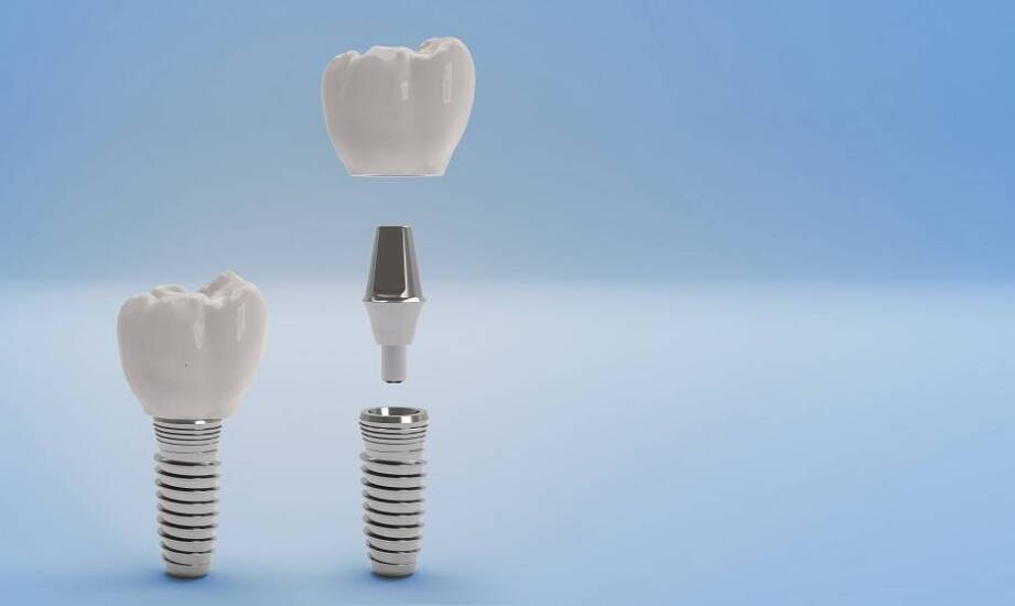 Stomatologiczna chirurgia a zęby na implantach – kluczowe informacje