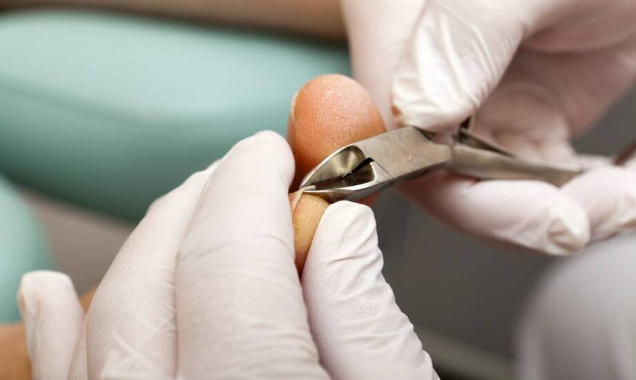 Wpływ klamer na wrastające paznokcie na codzienną aktywność