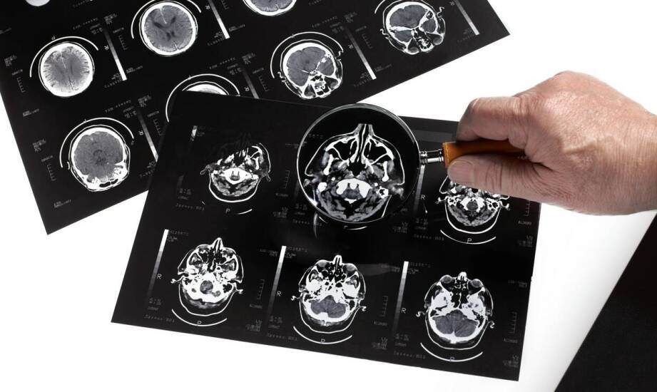 Leczenie oponiaków – na co zwrócić uwagę przed decyzją o operacji?