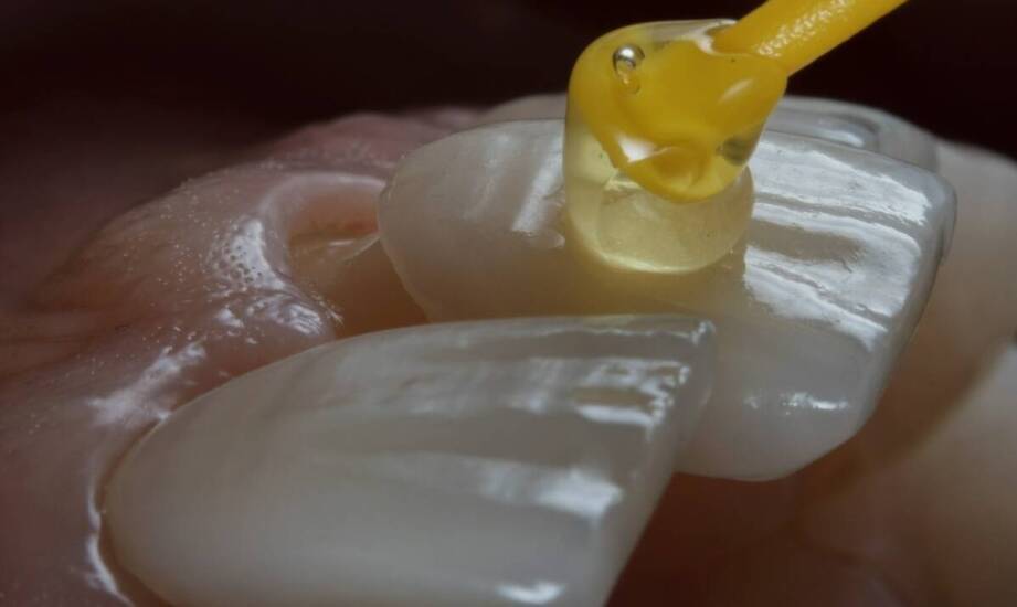 Żel Elmex jako wsparcie w leczeniu stanów zapalnych w jamie ustnej