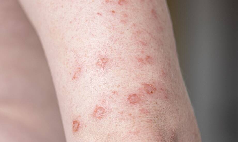 Jak leczyć świerzb za pomocą naszych preparatów bez recepty?