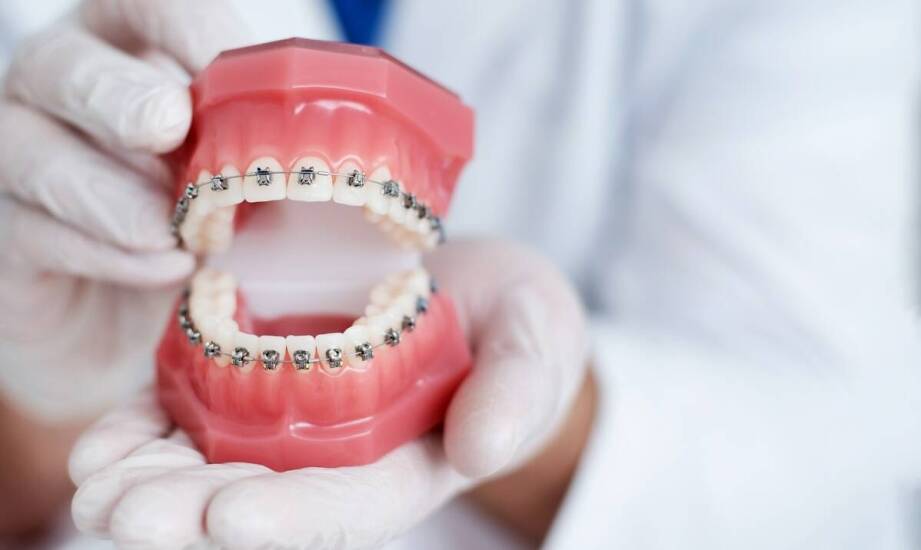 Czy istnieją różnice w trwałości między estetycznymi aparatami a tradycyjnymi?