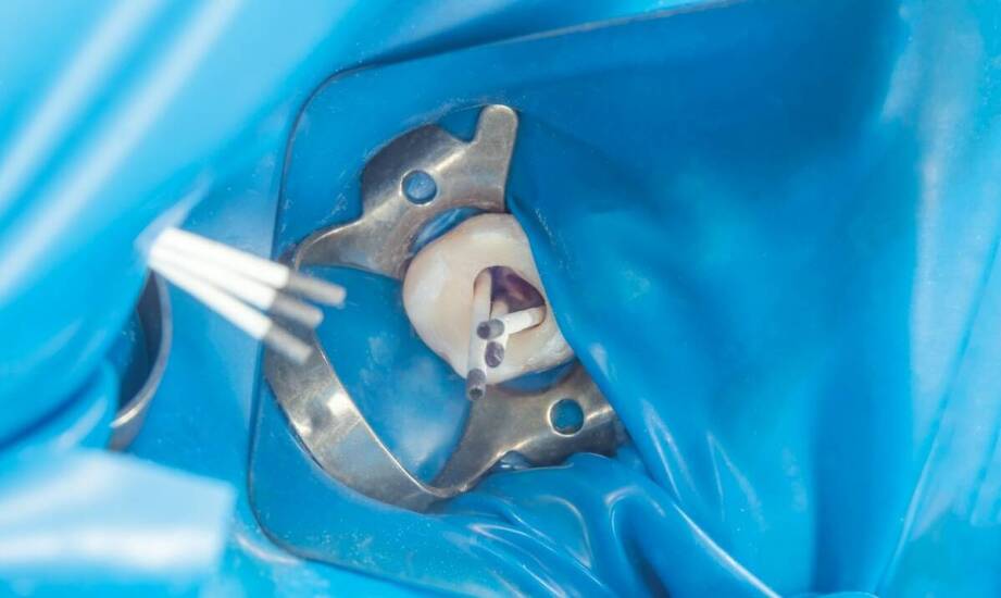 W jaki sposób endodoncja chroni przed utratą zębów?