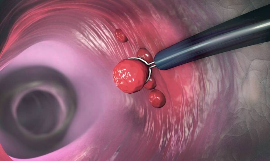 Kolonoskopia a wykrywanie polipów w jelicie grubym – dlaczego jest ważna?