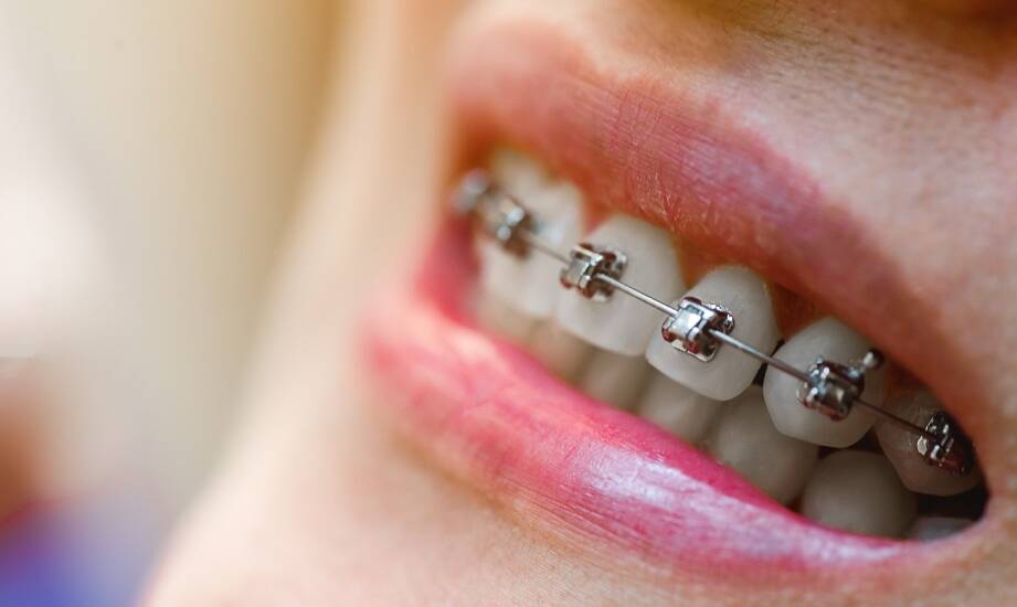 Jakie są najczęstsze błędy w higienie jamy ustnej przy noszeniu aparatu?